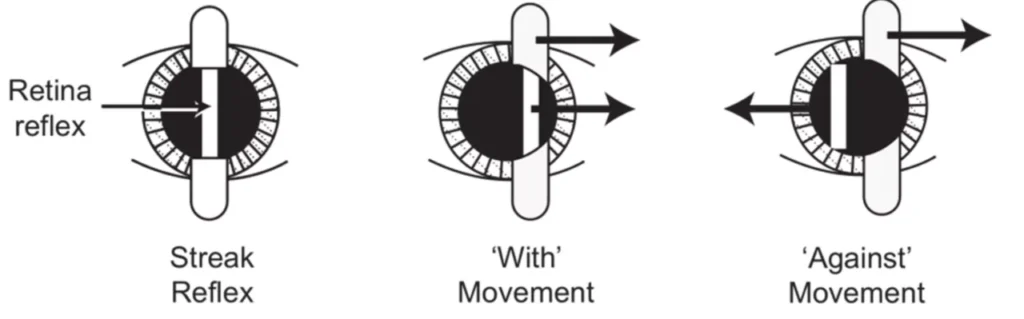 Red reflex movement with respect of the slit movement